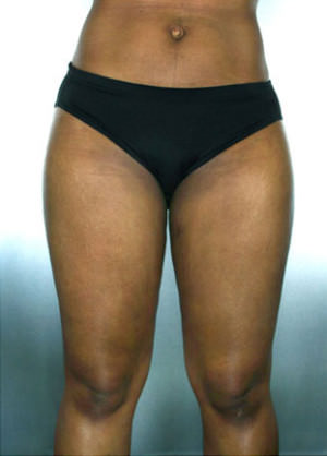 Liposuction Before & After Patient #8537