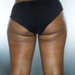 Liposuction Before & After Patient #8537