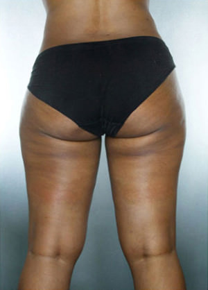 Liposuction Before & After Patient #8537