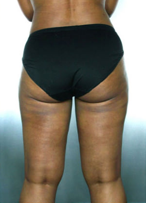 Liposuction Before & After Patient #8537