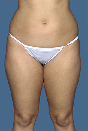 Liposuction Before & After Patient #8542