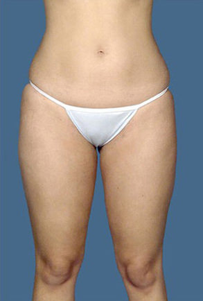 Liposuction Before & After Patient #8542