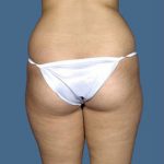 Liposuction Before & After Patient #8542