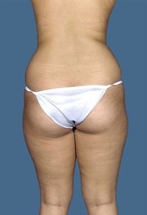 Liposuction Before & After Patient #8542