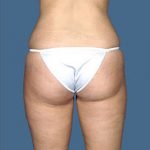 Liposuction Before & After Patient #8542
