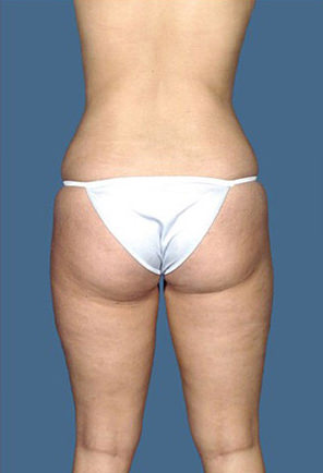 Liposuction Before & After Patient #8542