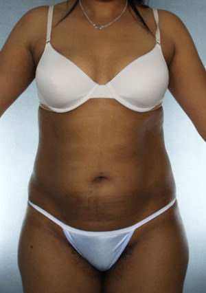 Liposuction Before & After Patient #8547