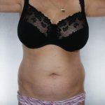 Liposuction Before & After Patient #8552