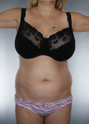 Liposuction Before & After Patient #8552