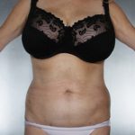 Liposuction Before & After Patient #8552