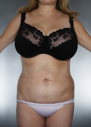 Liposuction Before & After Patient #8552