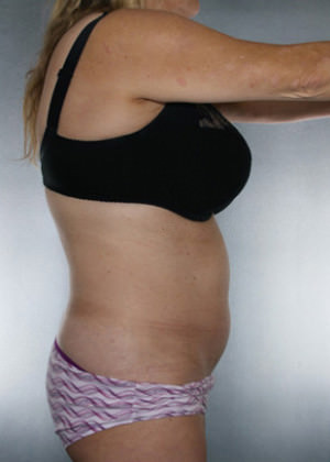 Liposuction Before & After Patient #8552