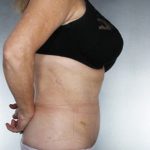 Liposuction Before & After Patient #8552