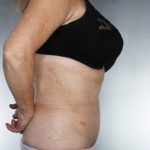 Liposuction Before & After Patient #8552