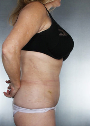 Liposuction Before & After Patient #8552