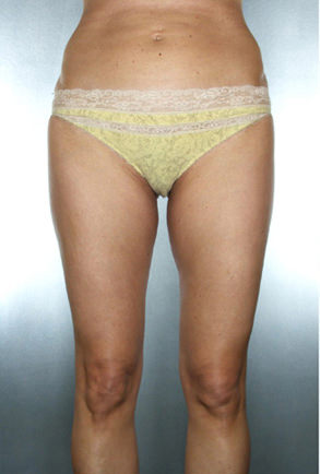 Liposuction Before & After Patient #8557