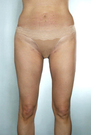 Liposuction Before & After Patient #8557