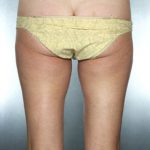 Liposuction Before & After Patient #8557