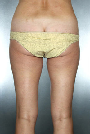 Liposuction Before & After Patient #8557