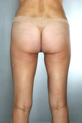 Liposuction Before & After Patient #8557