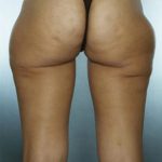 Liposuction Before & After Patient #8562