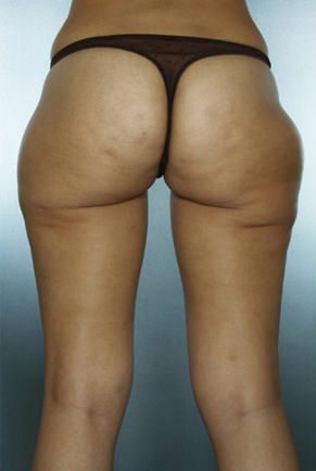 Liposuction Before & After Patient #8562
