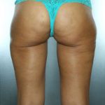 Liposuction Before & After Patient #8562