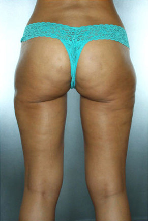 Liposuction Before & After Patient #8562