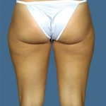 Liposuction Before & After Patient #8567
