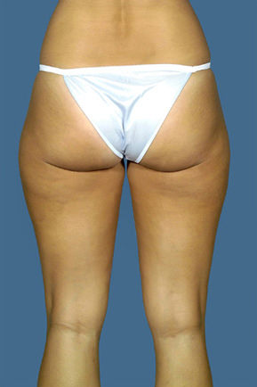 Liposuction Before & After Patient #8567