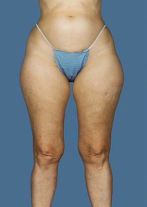 Liposuction Before & After Patient #8572