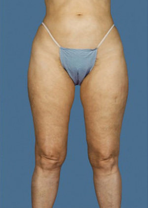 Liposuction Before & After Patient #8572