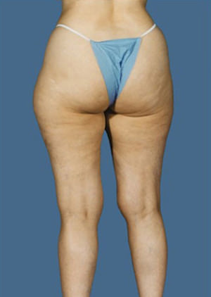 Liposuction Before & After Patient #8572