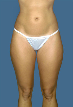 Liposuction Before & After Patient #8577