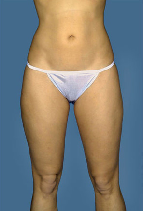 Liposuction Before & After Patient #8577