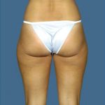 Liposuction Before & After Patient #8577