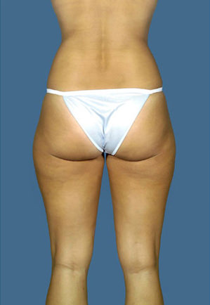 Liposuction Before & After Patient #8577