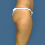 Liposuction Before & After Patient #8577