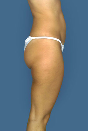 Liposuction Before & After Patient #8577