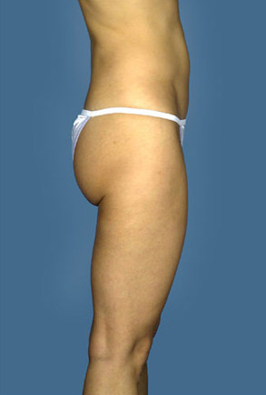 Liposuction Before & After Patient #8577