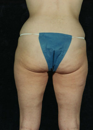 Liposuction Before & After Patient #8584