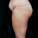 Liposuction Before & After Patient #8584