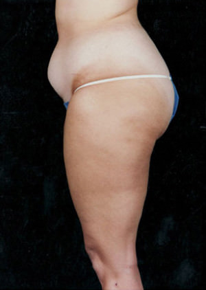 Liposuction Before & After Patient #8584