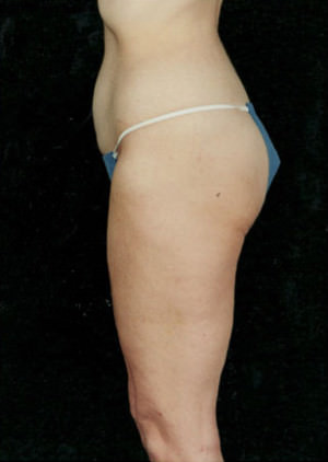 Liposuction Before & After Patient #8584