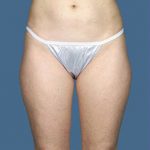 Liposuction Before & After Patient #8589