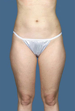 Liposuction Before & After Patient #8589