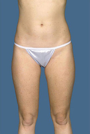 Liposuction Before & After Patient #8589