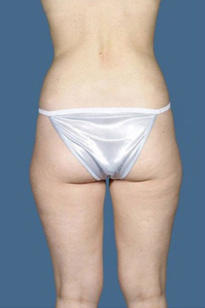 Liposuction Before & After Patient #8589