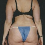 Liposuction Before & After Patient #8594