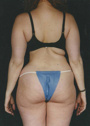 Liposuction Before & After Patient #8594